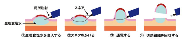 内視鏡的治療 Emr Esd 検査と治療 中野胃腸病院 中野胃腸病院 健診センターなかの 訪問看護ステーションなかの 医療法人 社団 以心会