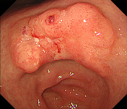 スキルス 胃がん 初期 症状