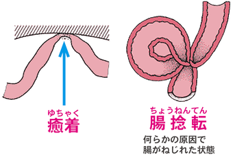 腸閉塞について | 病気の話 | 中野胃腸病院 | 中野胃腸病院・健診センターなかの・訪問看護ステーションなかの|医療法人 社団 以心会