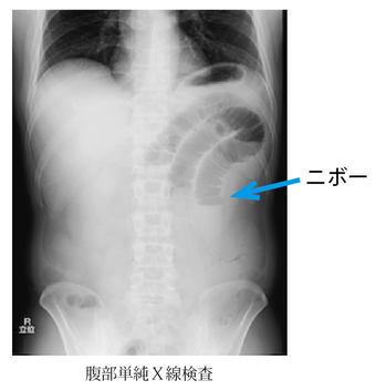 腸閉塞について | 病気の話 | 中野胃腸病院 | 中野胃腸病院・健診センターなかの・訪問看護ステーションなかの|医療法人 社団 以心会