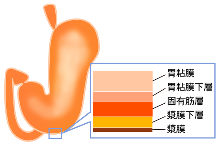 胃潰瘍とは 病気の話 中野胃腸病院 中野胃腸病院・健診センターなかの・訪問看護ステーションなかの 医療法人 社団 以心会