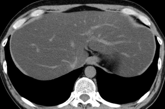 マロリー・ワイス断裂の症状